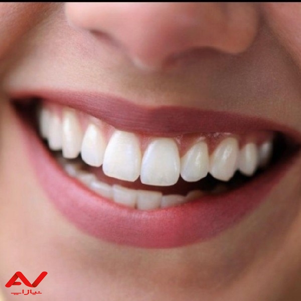ارائه خدمات دندانپزشکی زیبایی و ونیر کامپوزیت