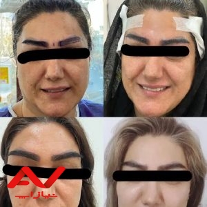 کاشت مو و ابروی طبیعی